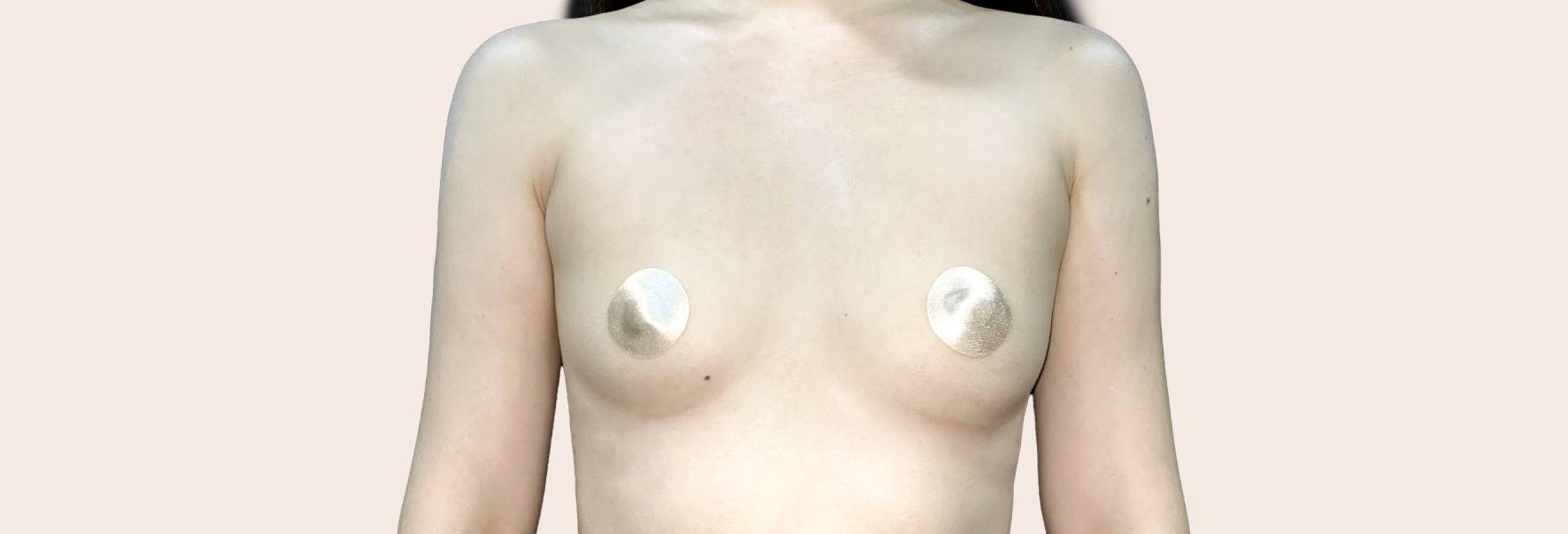 compare-breast-augmentation-before